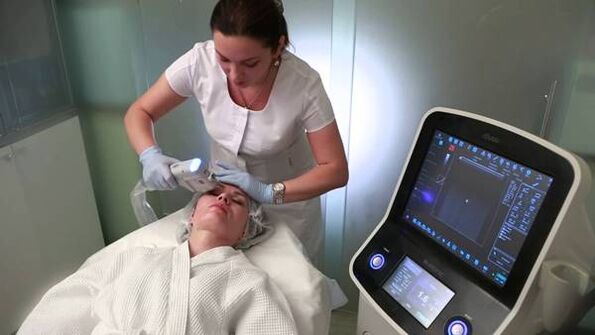 SMAS - ultrasonic lifting