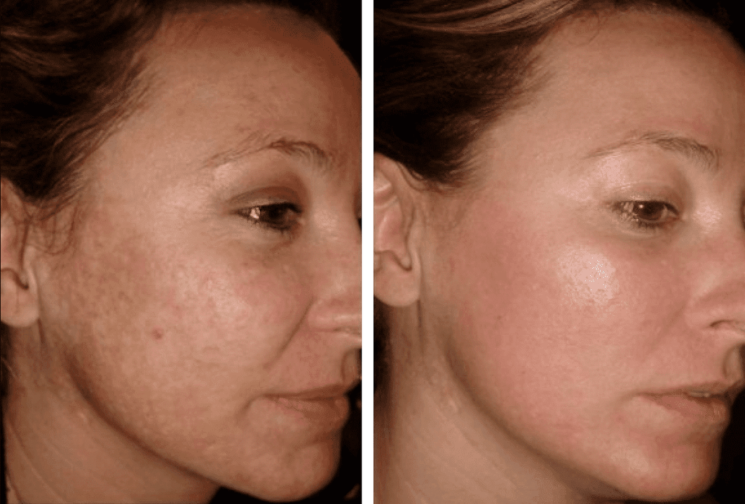 before and after laser skin rejuvenation photo 1